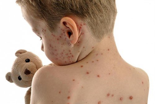 aktuelnosti Ovčije boginje - Varicella herpes zoster virus dom zdravlja Gornji Milanovac